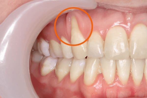 Tụt lợi khi niềng răng - "Kẻ thù" thầm lặng: Lộ diện nguyên nhân và cách đánh bại