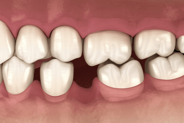 Giải đáp: Bị mất răng lâu năm có trồng Implant được không