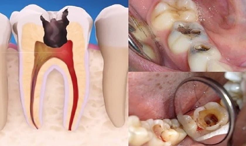 Nhức chân răng do nguyên nhân nào? Cách khắc phục ra sao?