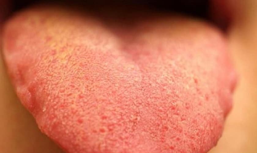 Đầu lưỡi nổi hột đỏ là biểu hiện của bệnh gì? Làm sao để chữa trị?