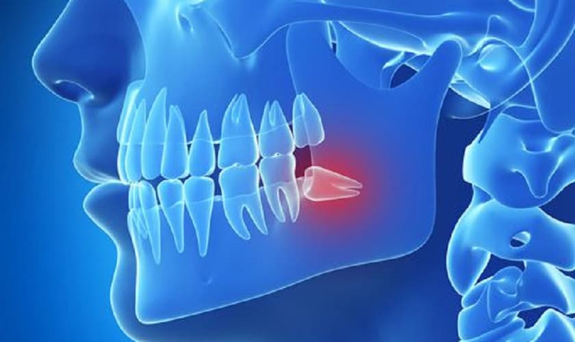 Bị đau quai hàm gần tai bên trái và các bệnh nha khoa có liên quan