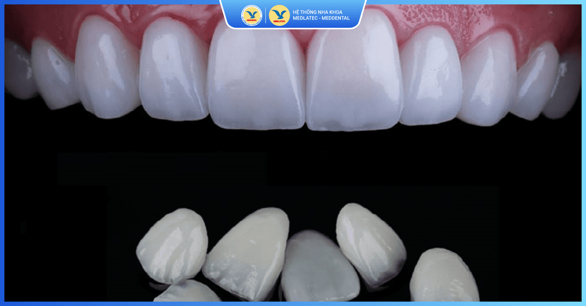 Dán sứ Veneer