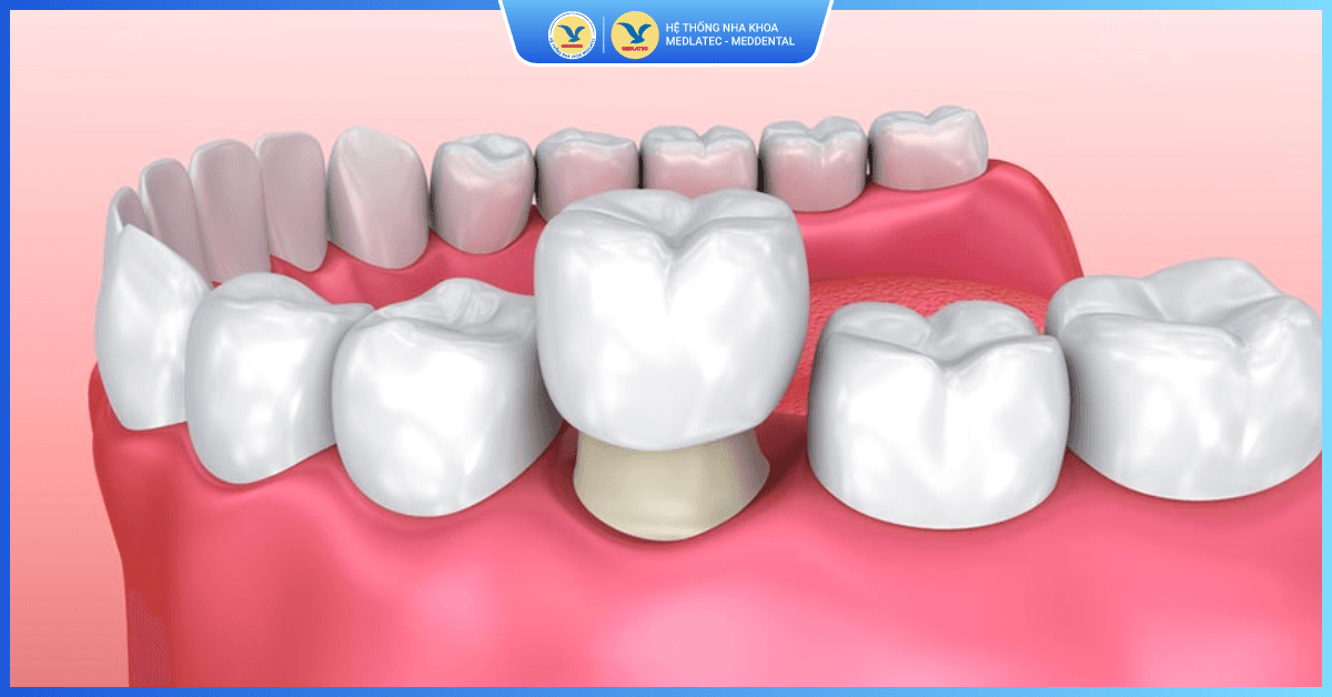 Bọc răng sứ thẩm mỹ