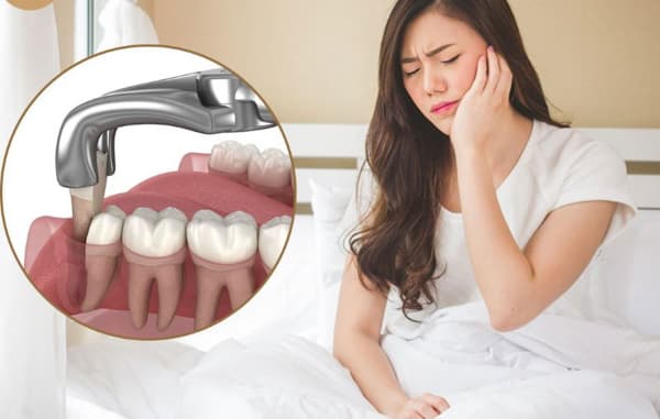 Hướng dẫn chăm sóc sau khi nhổ răng khôn mau lành vết thương