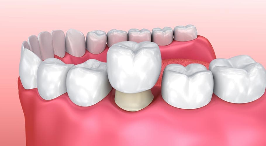 Có bầu nên bọc răng sứ không? Khi nào nên bọc?