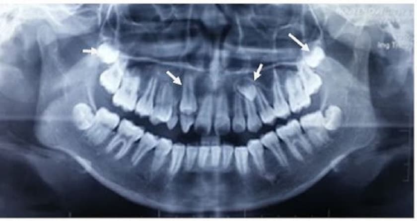 Phải làm sao nếu răng mọc ngầm?