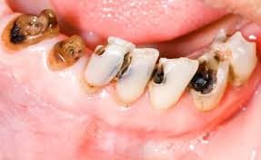 Nên làm gì khi răng bị sâu? Cách trị dứt điểm sâu răng