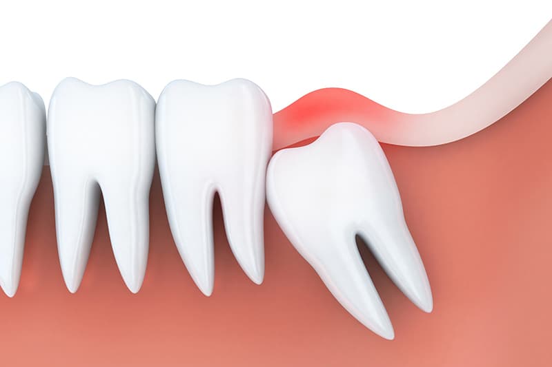 GIÚP BẠN TRẢ LỜI: NHỔ RĂNG KHÔN BAO LÂU THÌ LÀNH?