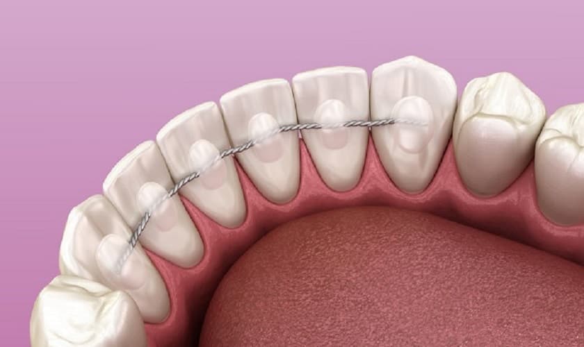 Ưu và nhược điểm của hàm duy trì cố định là gì?