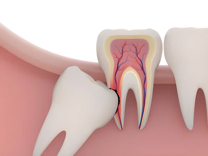 NHỔ RĂNG KHÔN CÓ NGUY HIỂM KHÔNG? NHỮNG LƯU Ý CẦN NẮM