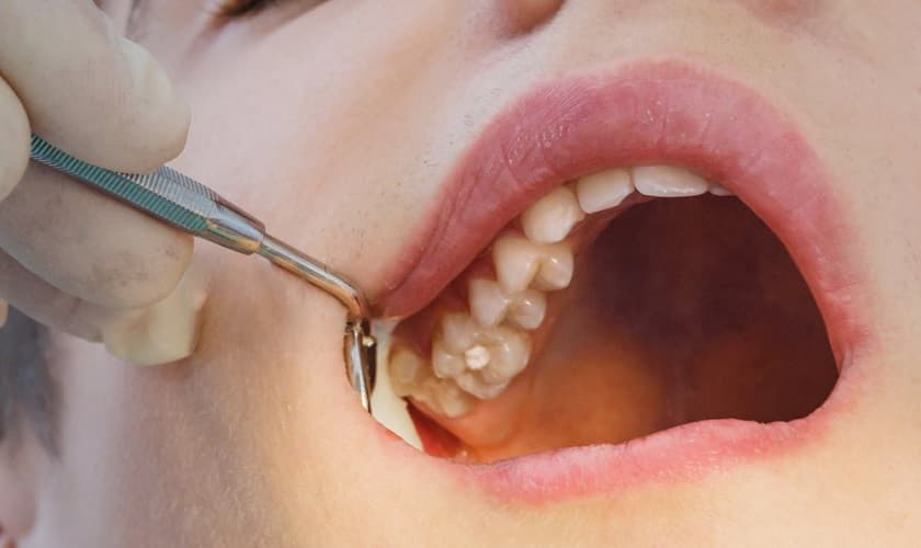 Dấu hiệu mọc răng khôn hàm trên và những lưu ý quan trọng