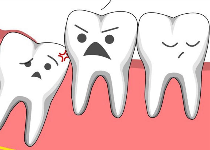 Biến chứng do răng khôn mọc lệch nhưng không nhổ