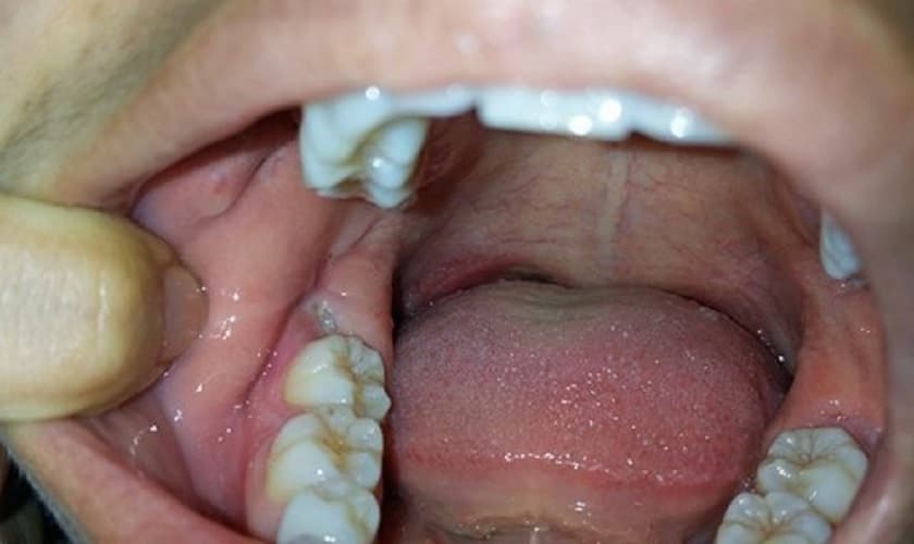 Sưng nướu răng trong cùng hàm dưới uống thuốc gì nhanh khỏi?