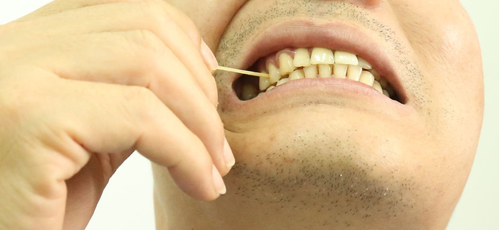 Tăm xỉa răng - Lợi ích mong manh và hệ lụy khó lường