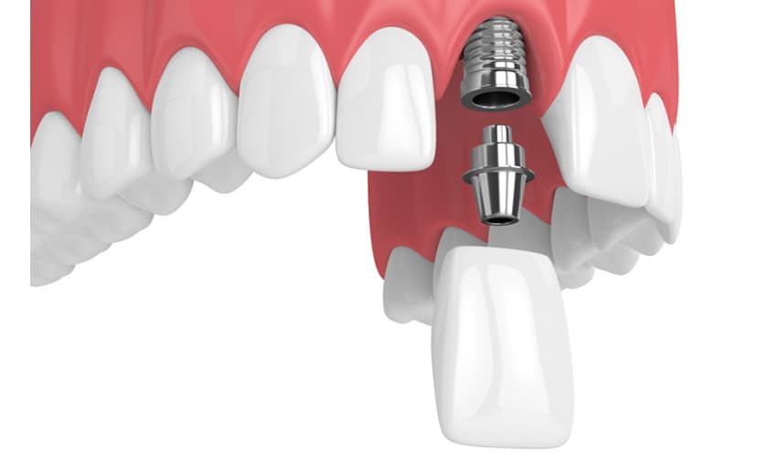 Cắm Implant răng cửa: Những điều cần biết trước khi thực hiện