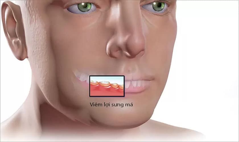 Sưng má trong miệng có nguy hiểm không? Điều trị như thế nào?