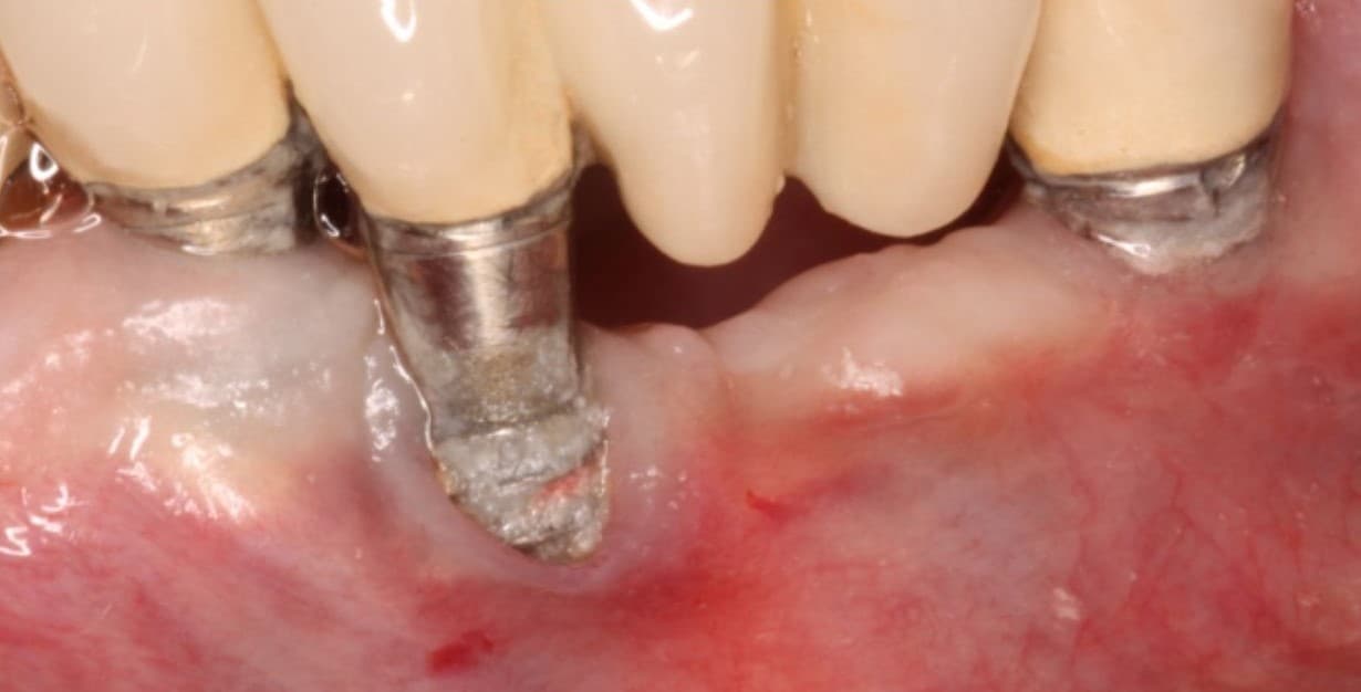 Gãy vít abutment là gì? Có thể thay thế abutment khác không?