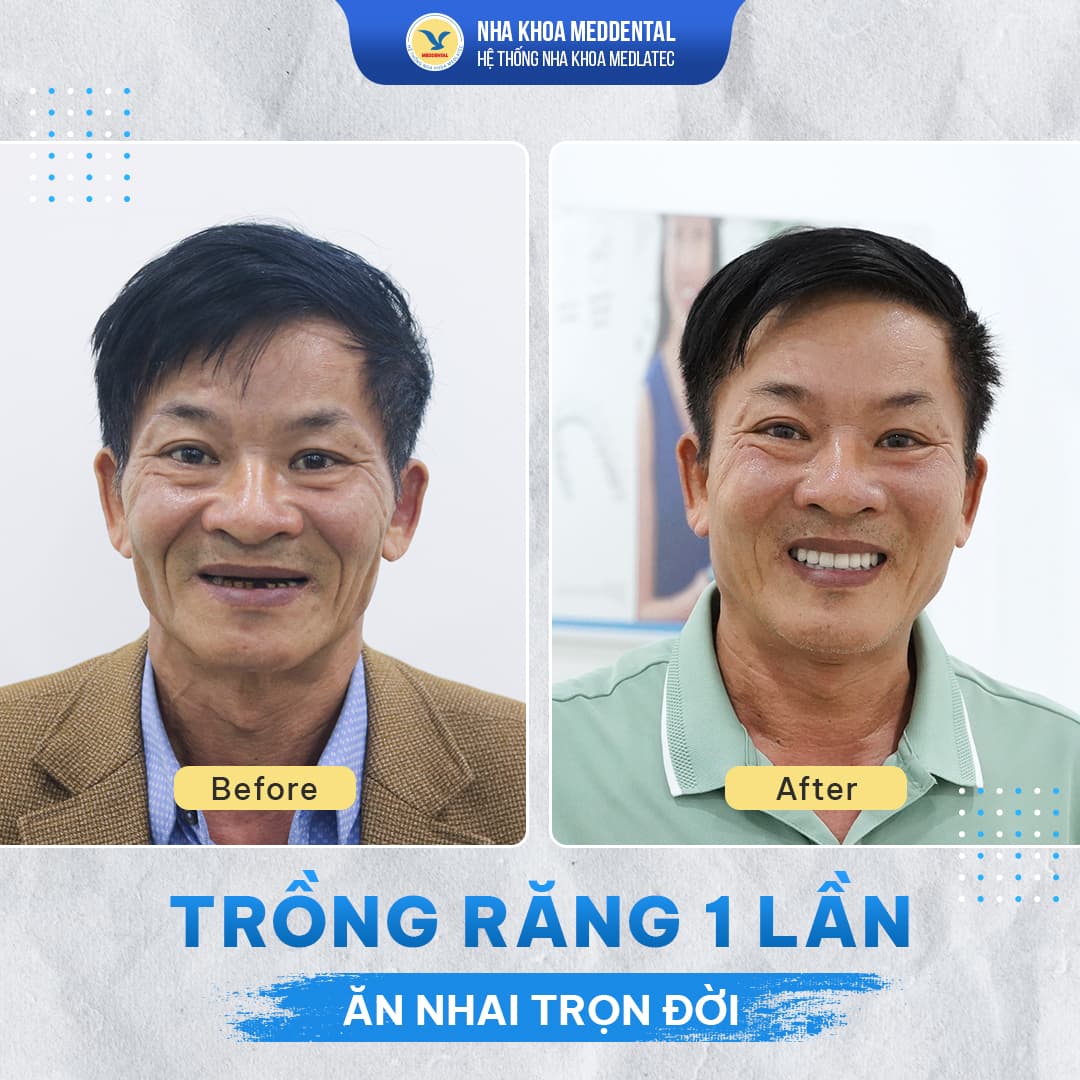 Mất răng không còn là nỗi lo với phương pháp trồng răng Implant