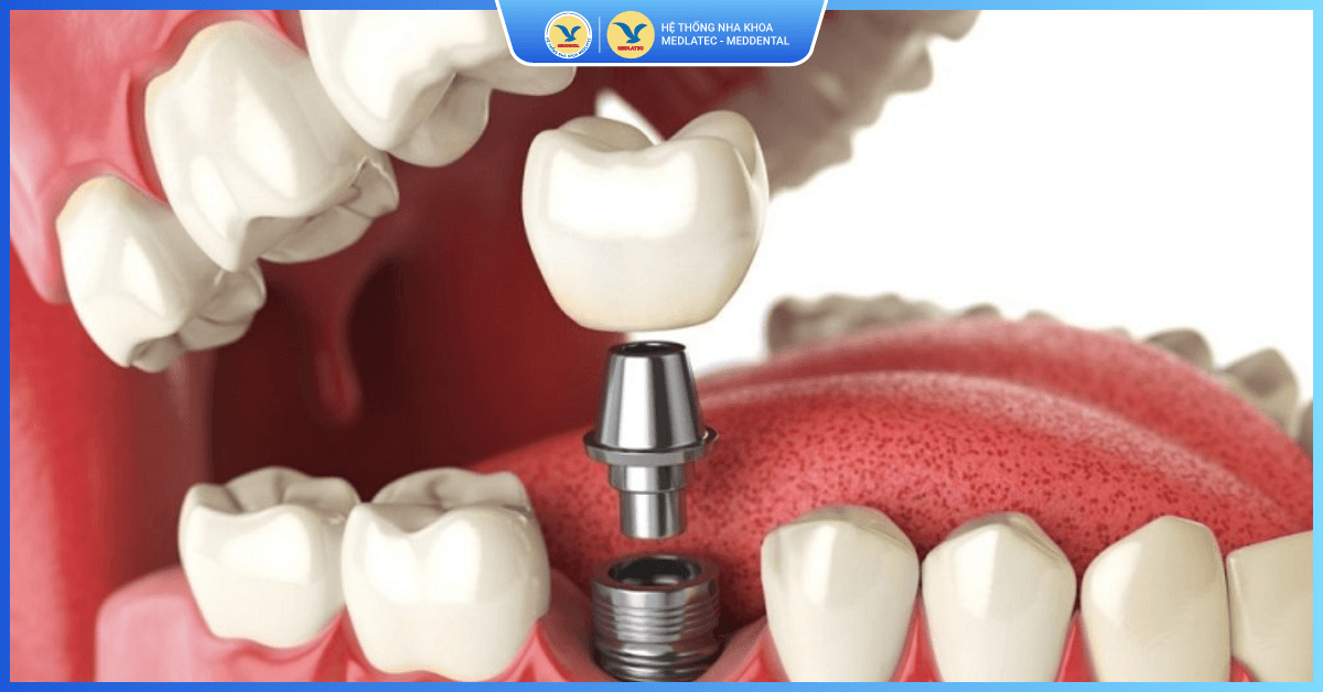 Cấy ghép răng Implant