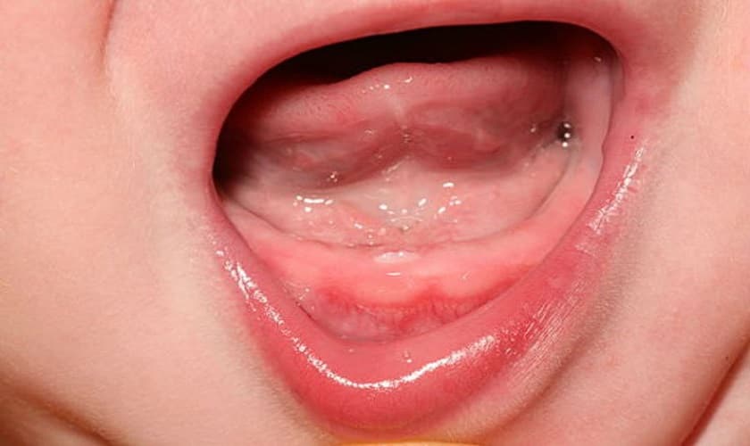 Trẻ chậm mọc răng do nguyên nhân nào? Làm sao để khắc phục?