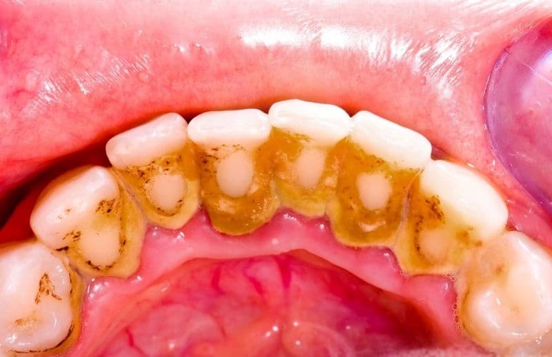 Lấy cao răng là gì? Có nên lấy cao răng không?