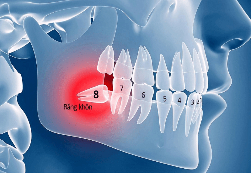 NHỔ RĂNG KHÔN BAO NHIÊU TIỀN? VÀ QUY TRÌNH THỰC HIỆN