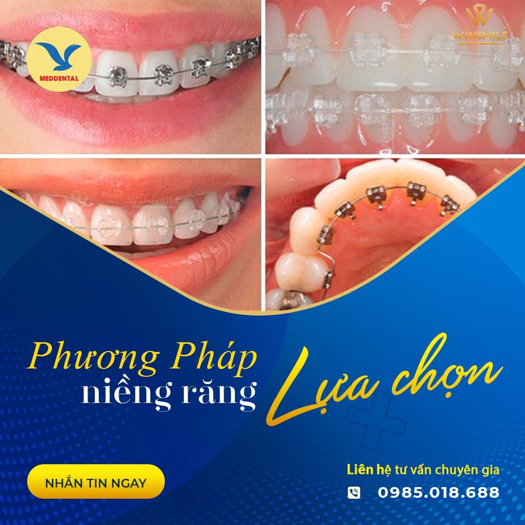 3 Yếu tố chính ảnh hưởng đến chi phí niềng răng ở trẻ