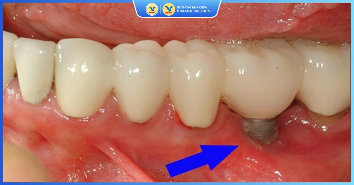 NGUYÊN NHÂN GÂY SƯNG “KÉO DÀI” TRỒNG RĂNG IMPLANT VÀ CÁCH THỨC XỬ LÝ AN TOÀN, HIỆU QUẢ