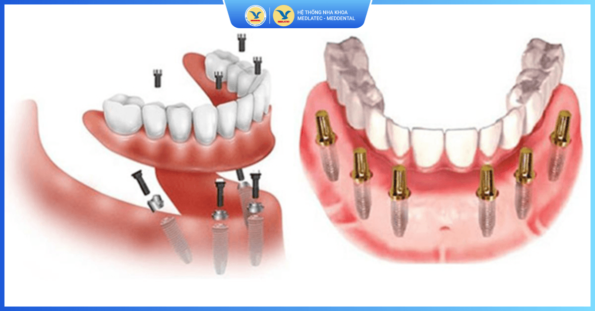 Kỹ thuật Implant All On