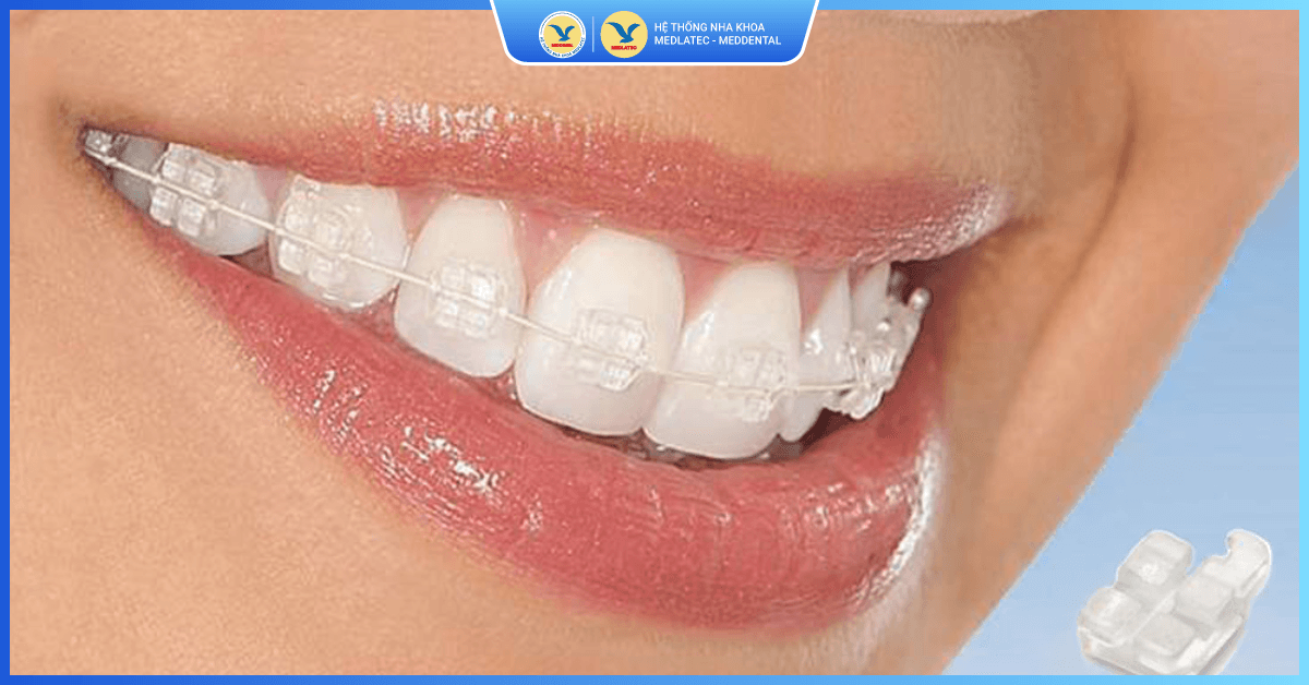 Niềng răng mắc cài sứ