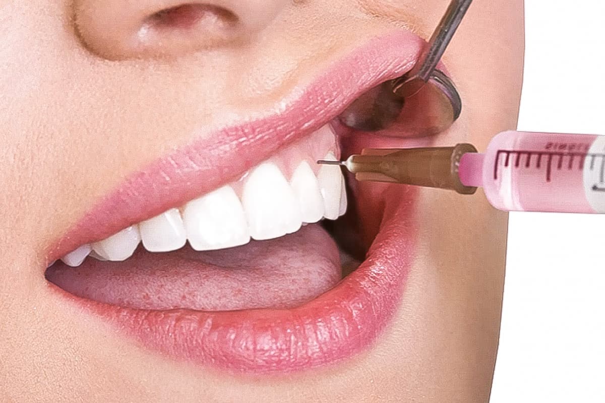 Những tác dụng phụ của thuốc gây tê khi nhổ răng nên biết