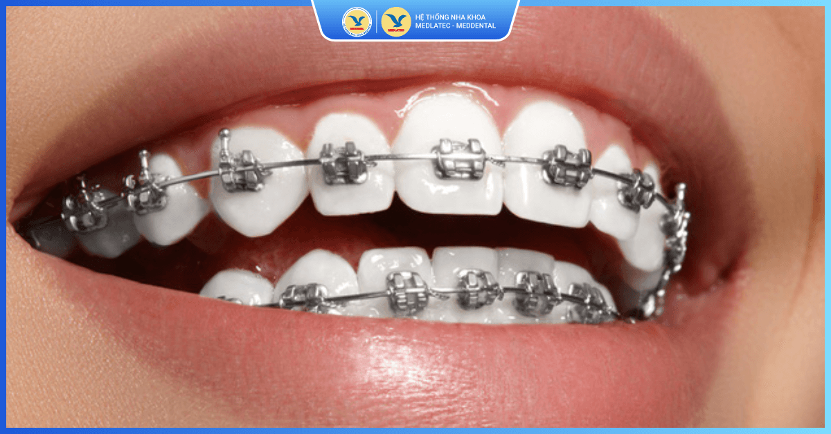 Niềng răng thẩm mỹ