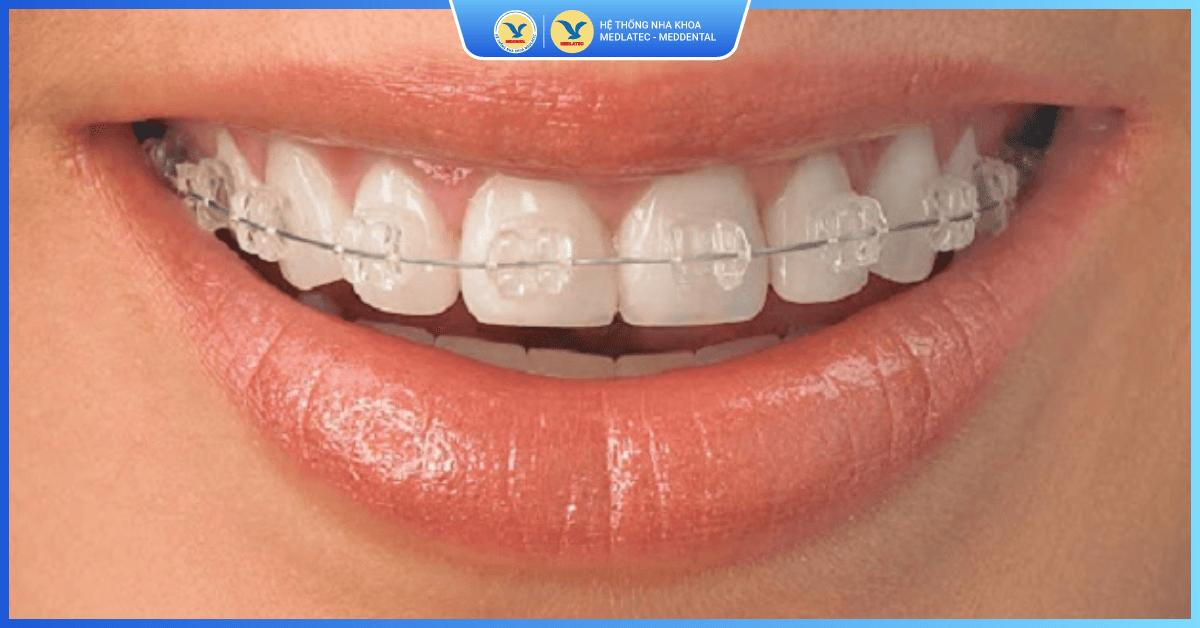 Niềng răng mắc cài pha lê