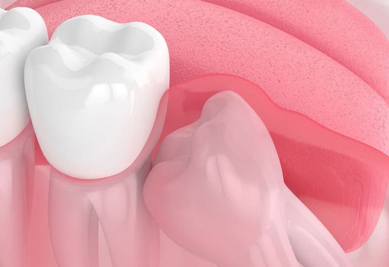 KHI NÀO NÊN NHỔ RĂNG KHÔN? NÊN NHỔ Ở ĐÂU?