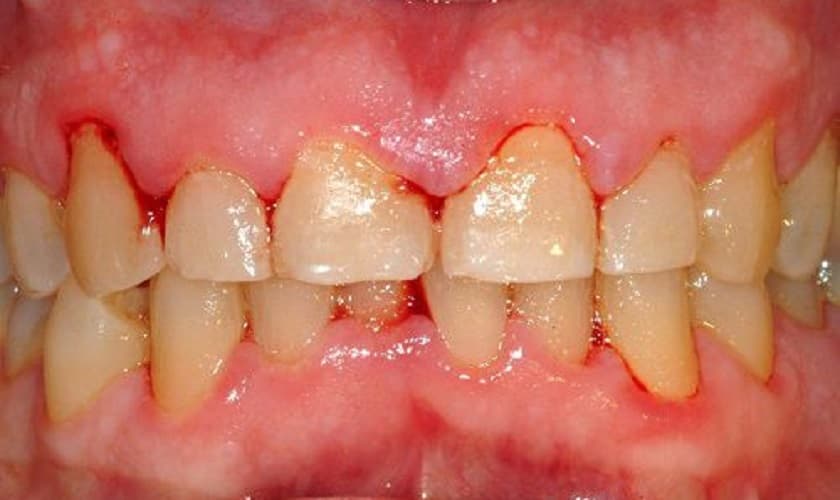 Nguyên nhân và cách khắc phục hiện tượng chảy máu chân răng