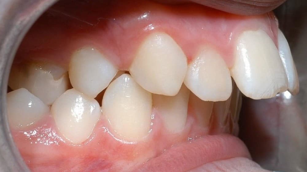 Răng hô là gì – 3 phương pháp khắc phục hiệu quả