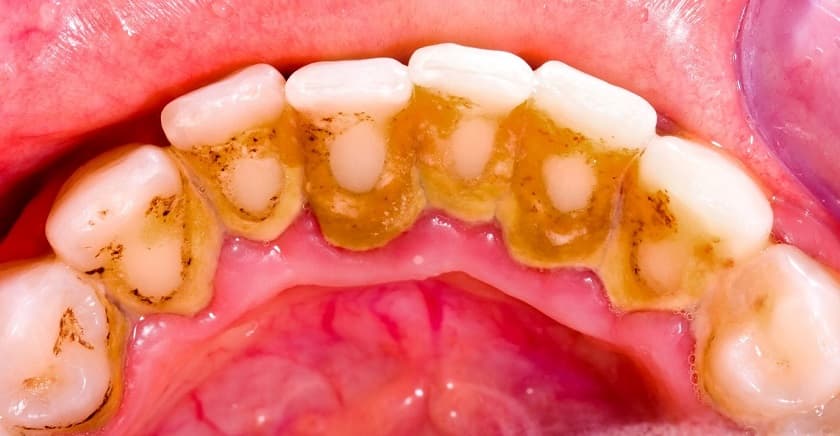 Làm gì khi răng có vết đen? Cách xử lý hiệu quả