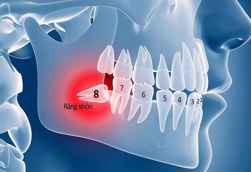 KHI NÀO NÊN NHỔ RĂNG KHÔN VÀ NHỮNG CÂU HỎI THƯỜNG GẶP
