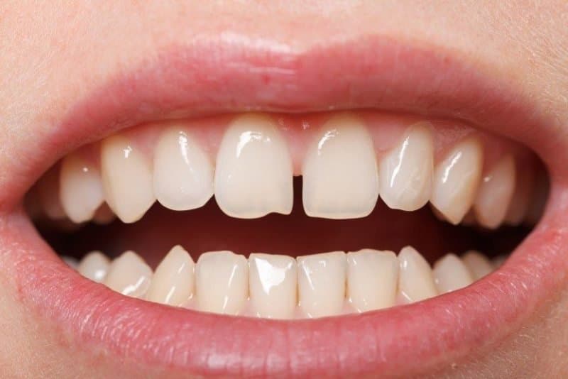 Răng thưa có niềng được không? Thời gian niềng trong bao lâu