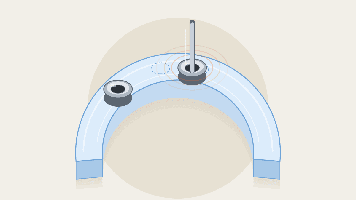 Quy trình trồng răng Implant có máng hướng dẫn: 5 bước