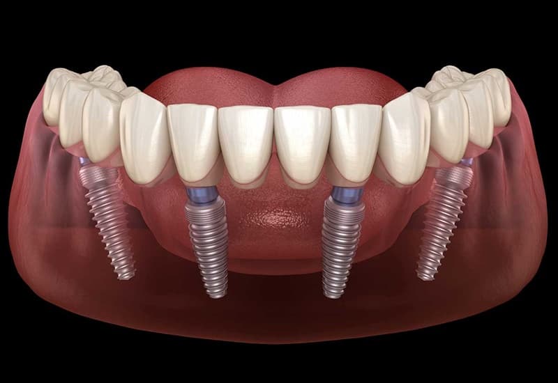 Kỹ thuật Implant All On: Giải pháp hoàn hảo cho người mất răng
