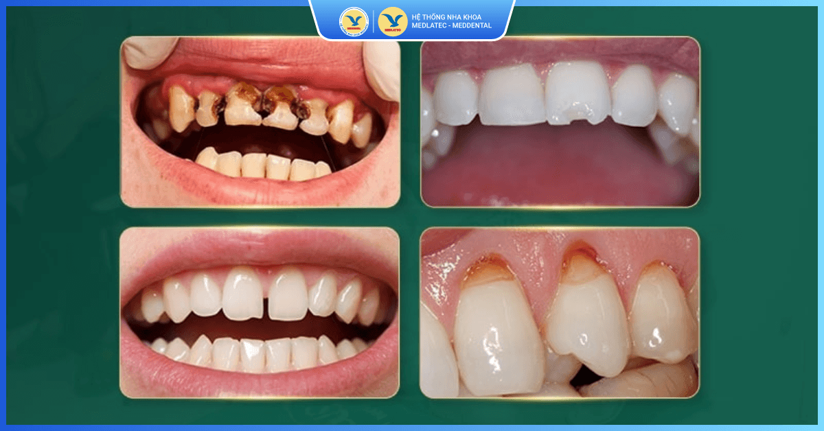 Trám răng thẩm mỹ