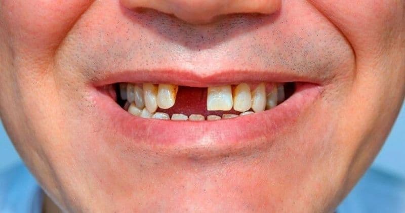 Mất răng cửa có thể gây ra những tác hại gì? những lưu ý khi trồng răng cửa