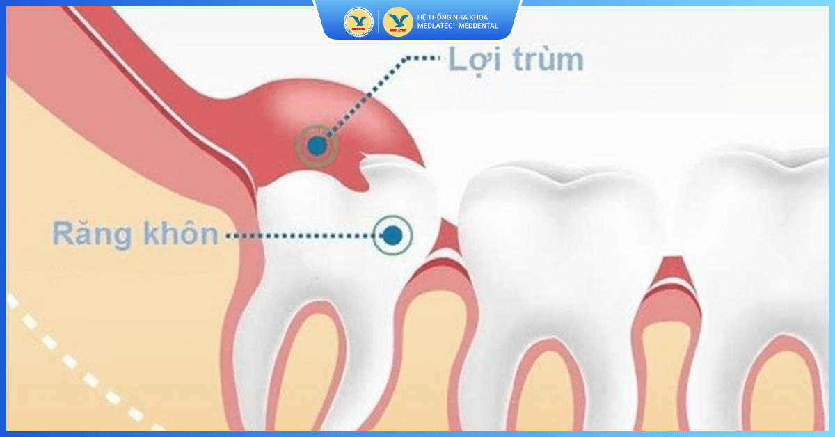 Cắt lợi trùm