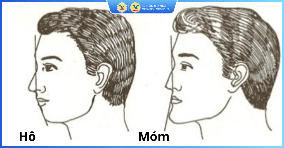 Chỉnh răng hô móm
