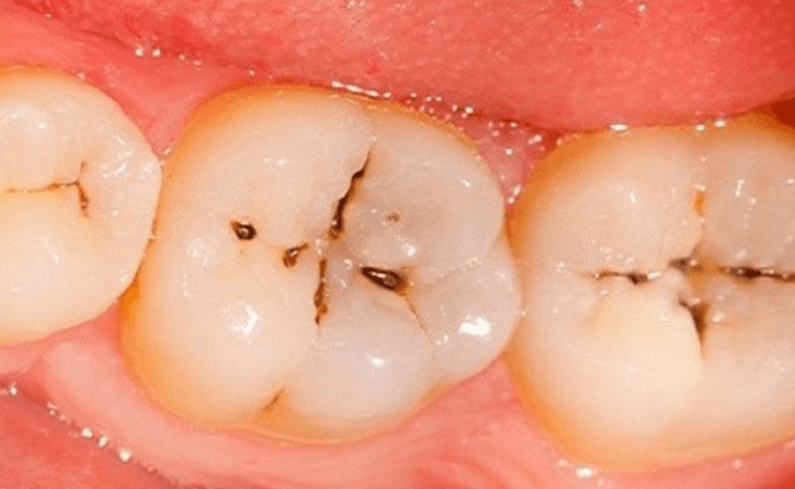 Vết đen trên răng hàm: Nguyên nhân và cách loại bỏ