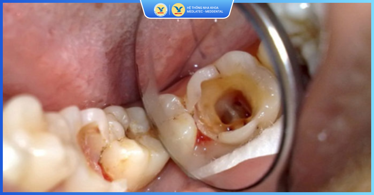 Trường hợp không thể hàn trám răng? - Hàn răng