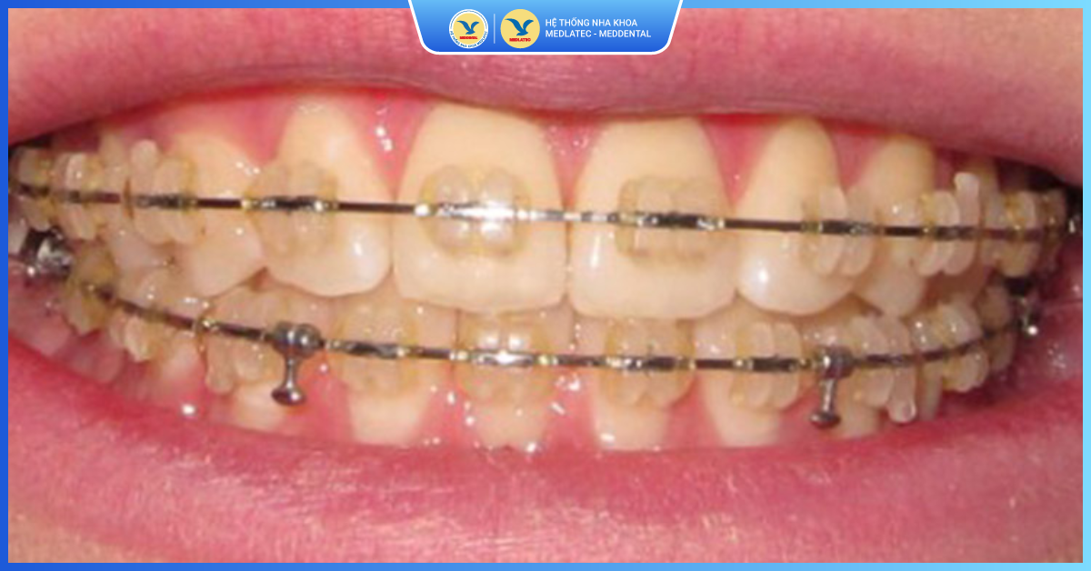 Niềng răng mắc cài sứ bị vàng - Niềng răng mắc cài sứ