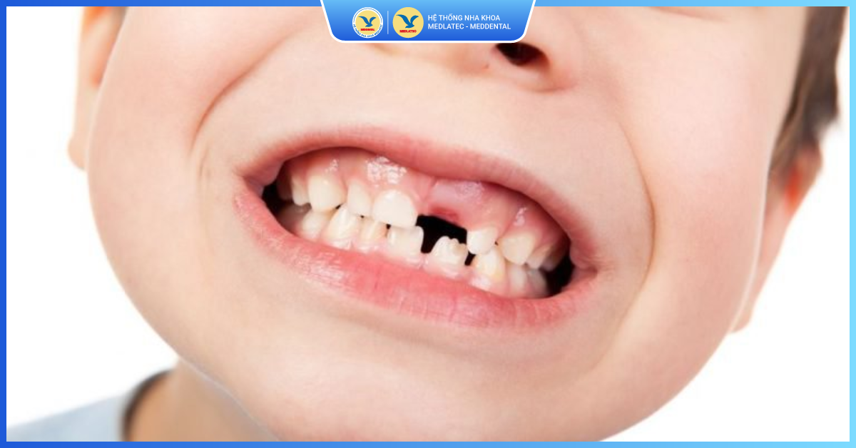 Răng sữa chưa lung lay khi đến tuổi mọc răng vĩnh viễn - Nhổ răng sữa cho trẻ em