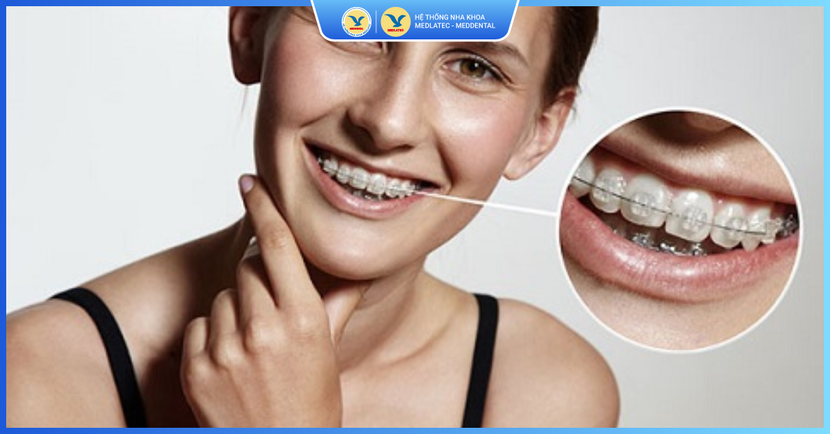 Độ bền - Niềng răng mắc cài pha lê